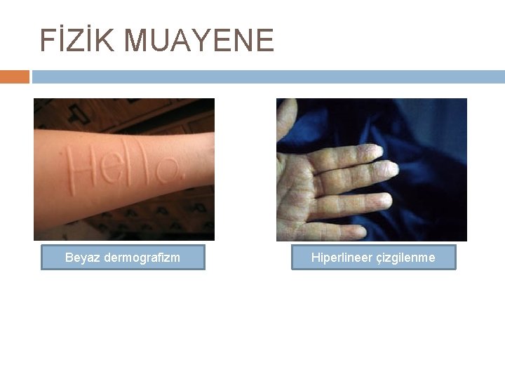 FİZİK MUAYENE Beyaz dermografizm Hiperlineer çizgilenme 