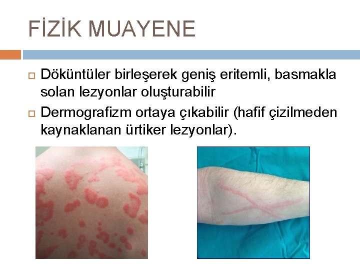 FİZİK MUAYENE Döküntüler birleşerek geniş eritemli, basmakla solan lezyonlar oluşturabilir Dermografizm ortaya çıkabilir (hafif