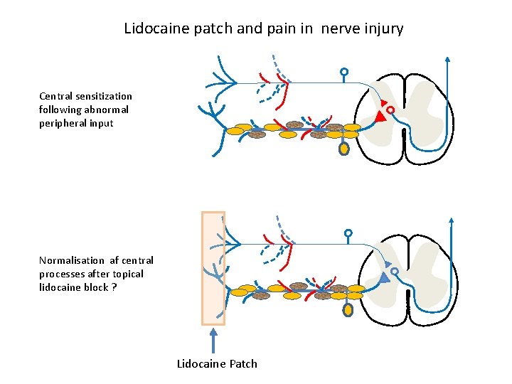 Lidocaine patch and pain in nerve injury Central sensitization following abnormal peripheral input Normalisation