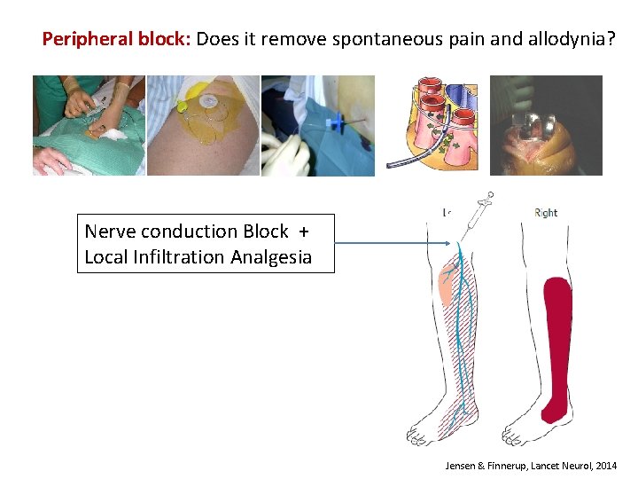 Peripheral block: Does it remove spontaneous pain and allodynia? Nerve conduction Block + Local
