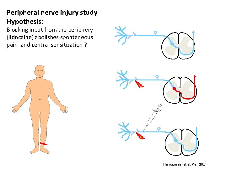 Peripheral nerve injury study Hypothesis: Blocking input from the periphery (lidocaine) abolishes spontaneous pain
