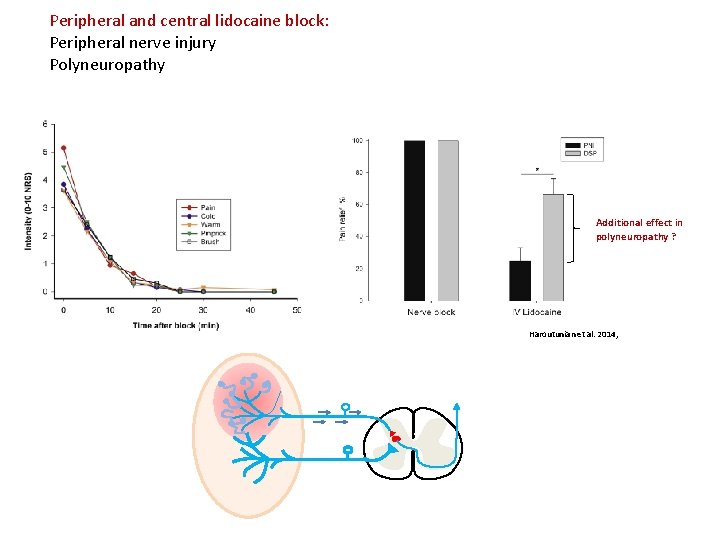 Peripheral and central lidocaine block: Peripheral nerve injury Polyneuropathy Additional effect in polyneuropathy ?