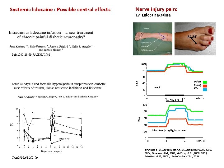 Systemic lidocaine : Possible central effects Nerve injury pain: i. v. Lidocaine/saline scar Pain