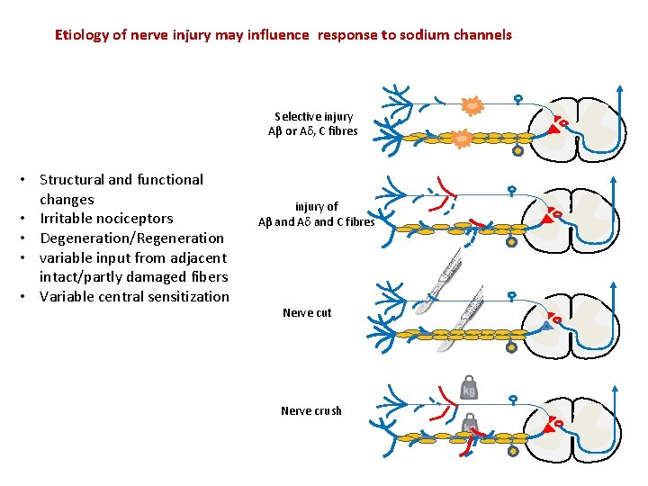 Etiology of nerve injury may influence response to sodium channels Selective injury Aβ or