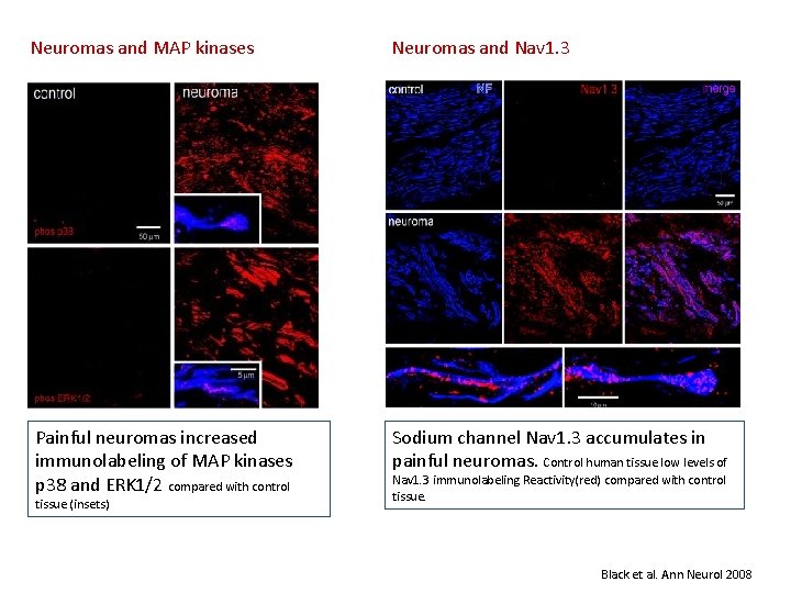 Neuromas and MAP kinases Neuromas and Nav 1. 3 Painful neuromas increased immunolabeling of