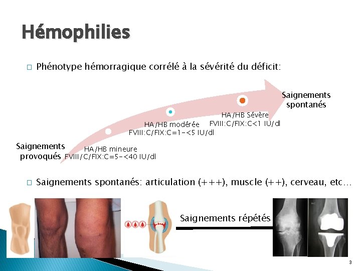 INTRODUCTION Hémophilies � Phénotype hémorragique corrélé à la sévérité du déficit: HA/HB Sévère HA/HB INTRODUCTION Hémophilies � Phénotype hémorragique corrélé à la sévérité du déficit: HA/HB Sévère HA/HB