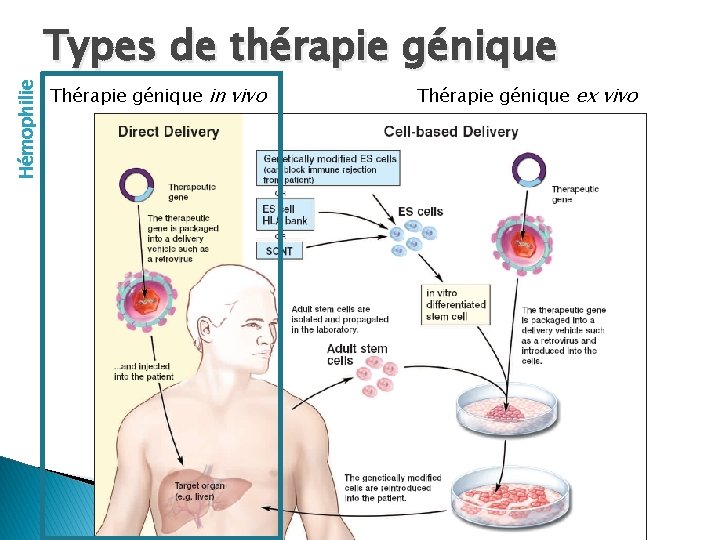 Hémophilie Types de thérapie génique Thérapie génique in vivo Thérapie génique ex vivo Hémophilie Types de thérapie génique Thérapie génique in vivo Thérapie génique ex vivo