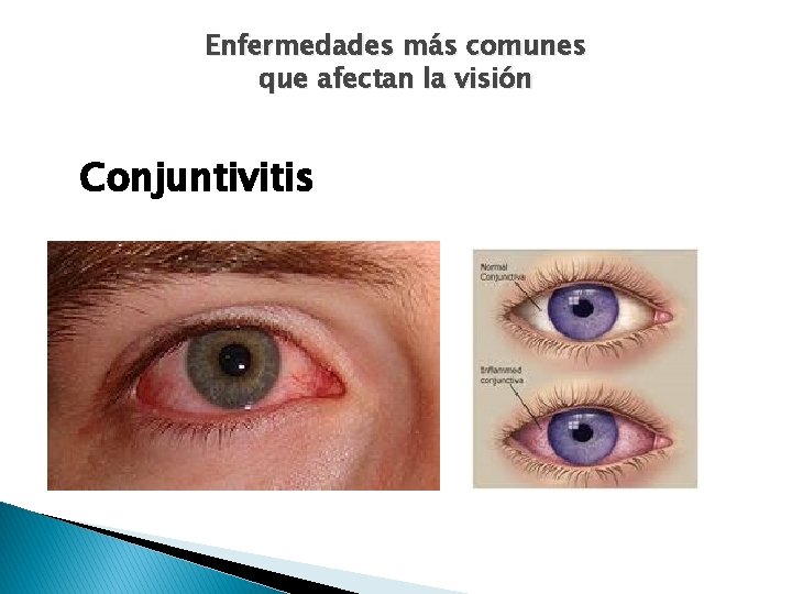 Enfermedades más comunes que afectan la visión Conjuntivitis 