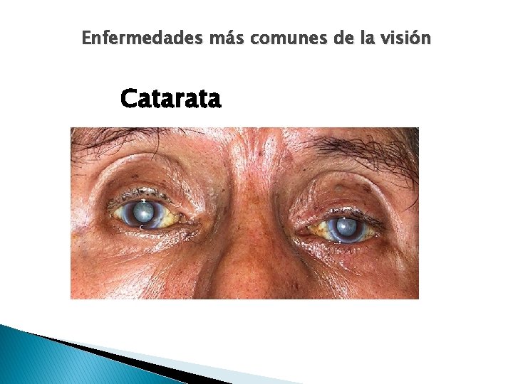 Enfermedades más comunes de la visión Catarata 