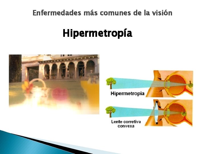 Enfermedades más comunes de la visión Hipermetropía 