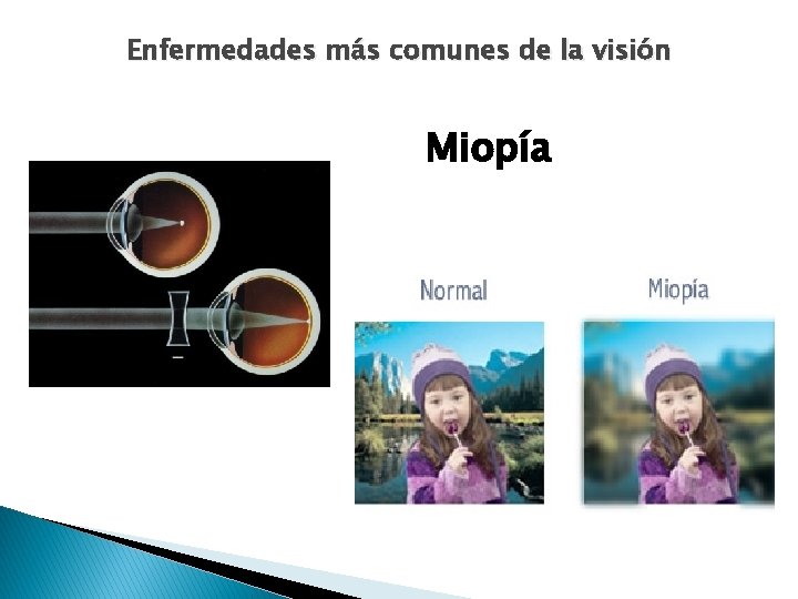 Enfermedades más comunes de la visión Miopía 