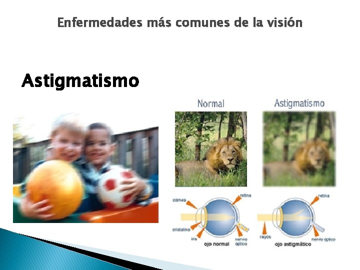 Enfermedades más comunes de la visión Astigmatismo 