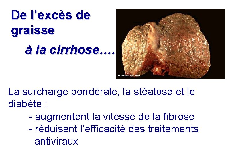 De l’excès de graisse à la cirrhose…. La surcharge pondérale, la stéatose et le De l’excès de graisse à la cirrhose…. La surcharge pondérale, la stéatose et le
