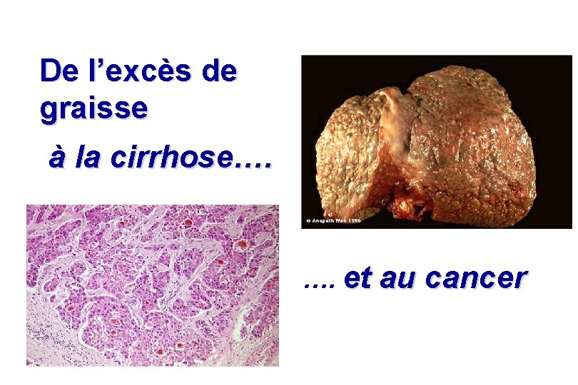 De l’excès de graisse à la cirrhose…. …. et au cancer De l’excès de graisse à la cirrhose…. …. et au cancer