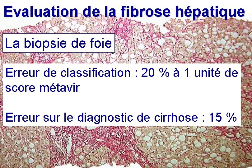 Evaluation de la fibrose hépatique La biopsie de foie Erreur de classification : 20 Evaluation de la fibrose hépatique La biopsie de foie Erreur de classification : 20