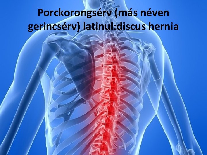 Porckorongsérv (más néven gerincsérv) latinul: discus hernia 