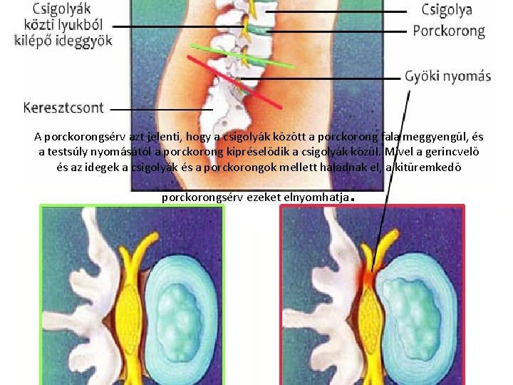 A porckorongsérv azt jelenti, hogy a csigolyák között a porckorong fala meggyengül, és a