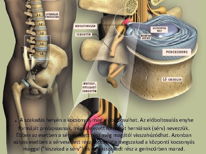 . A szakadás helyén a kocsonyás mag előboltosulhat. Az előboltosulás enyhe formáját prolapsusnak, míg