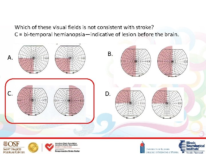 Which of these visual fields is not consistent with stroke? C = bi-temporal hemianopsia—indicative