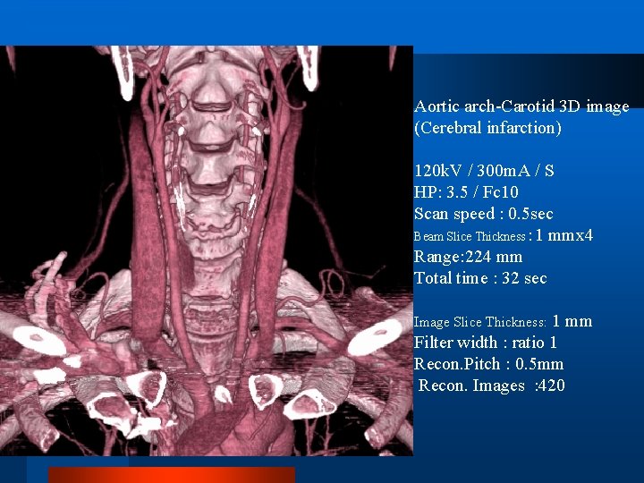 Aortic arch-Carotid 3 D image (Cerebral infarction) 120 k. V / 300 m. A