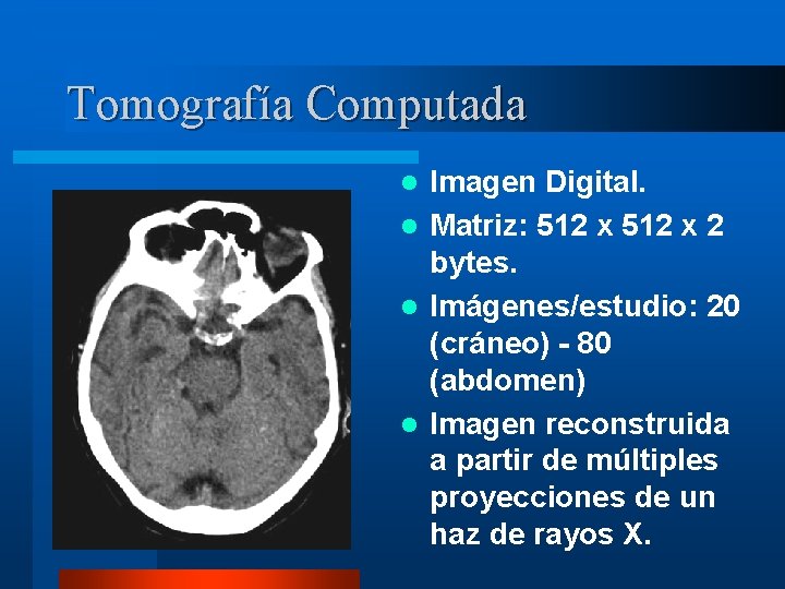Tomografía Computada Imagen Digital. l Matriz: 512 x 2 bytes. l Imágenes/estudio: 20 (cráneo)