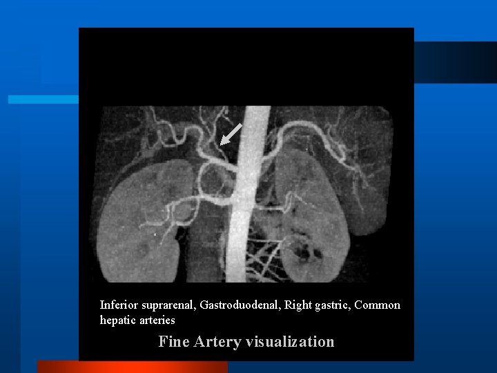 Inferior suprarenal, Gastroduodenal, Right gastric, Common hepatic arteries Fine Artery visualization 