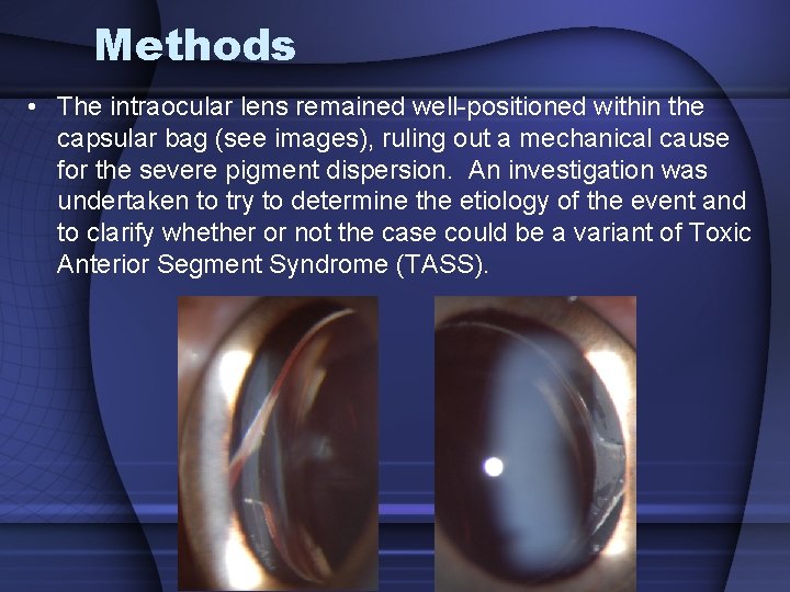 Methods • The intraocular lens remained well-positioned within the capsular bag (see images), ruling