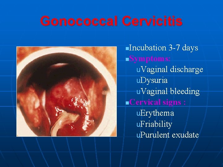 Gonococcal Cervicitis Incubation 3 -7 days n. Symptoms: u. Vaginal discharge u. Dysuria u.
