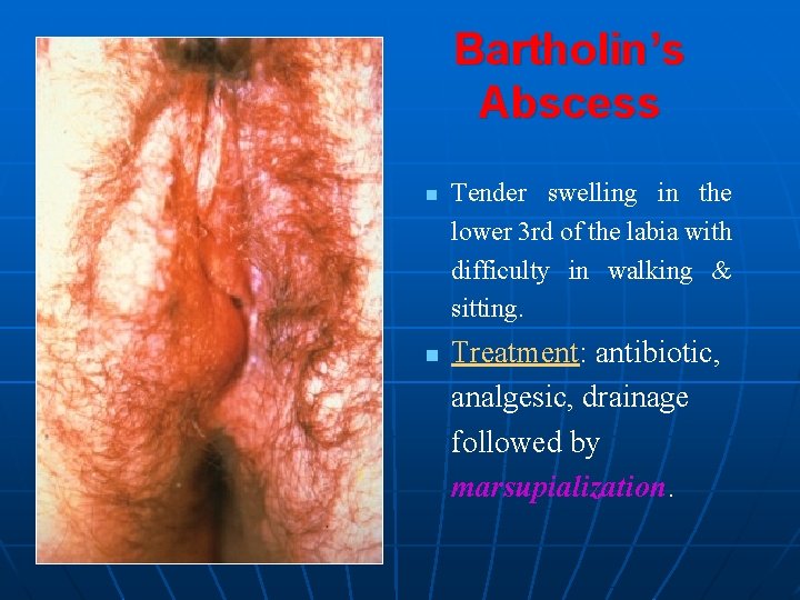 Bartholin’s Abscess n n Tender swelling in the lower 3 rd of the labia