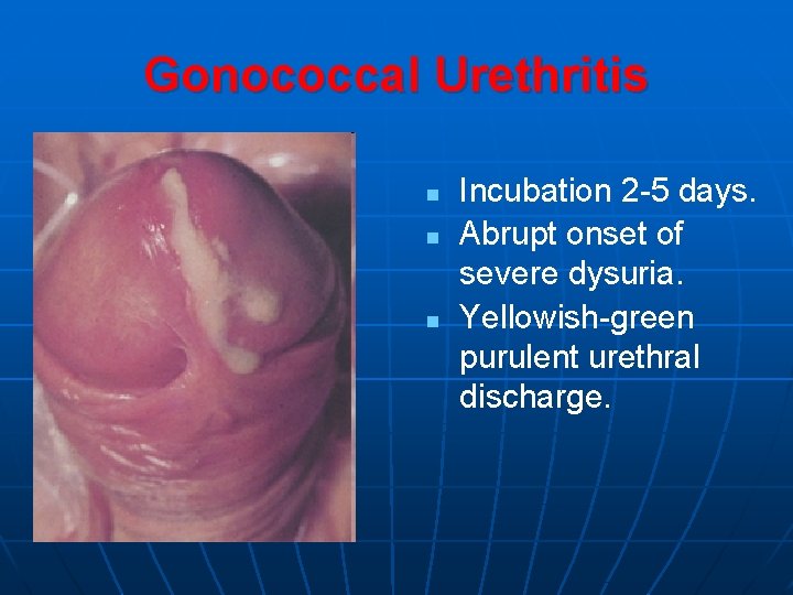 Gonococcal Urethritis n n n Incubation 2 -5 days. Abrupt onset of severe dysuria.