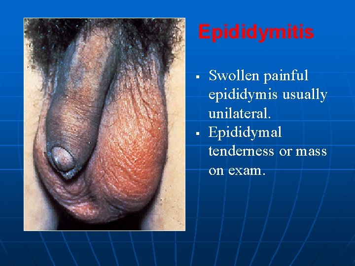 Epididymitis § § Swollen painful epididymis usually unilateral. Epididymal tenderness or mass on exam.