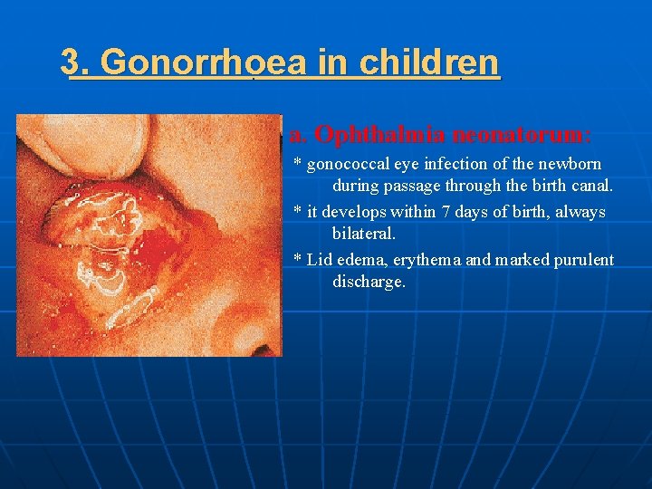 3. Gonorrhoea in children a. Ophthalmia neonatorum: * gonococcal eye infection of the newborn