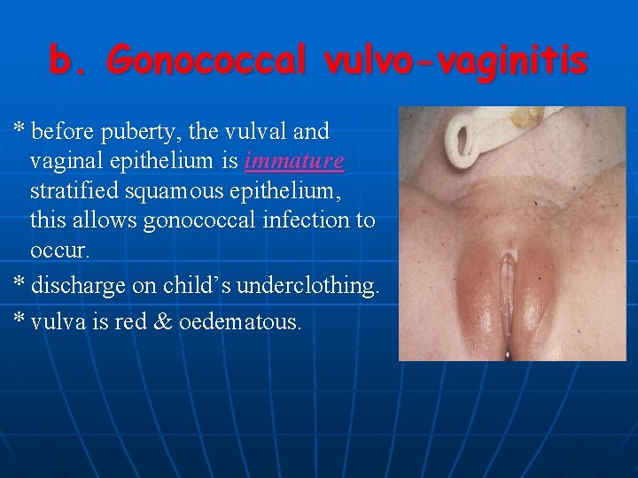 b. Gonococcal vulvo-vaginitis * before puberty, the vulval and vaginal epithelium is immature stratified
