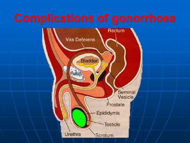 Complications of gonorrhoea 