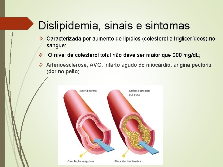 Dislipidemia, sinais e sintomas Caracterizada por aumento de lipídios (colesterol e triglicerídeos) no sangue;