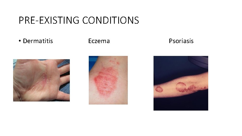 PRE-EXISTING CONDITIONS • Dermatitis Eczema Psoriasis 