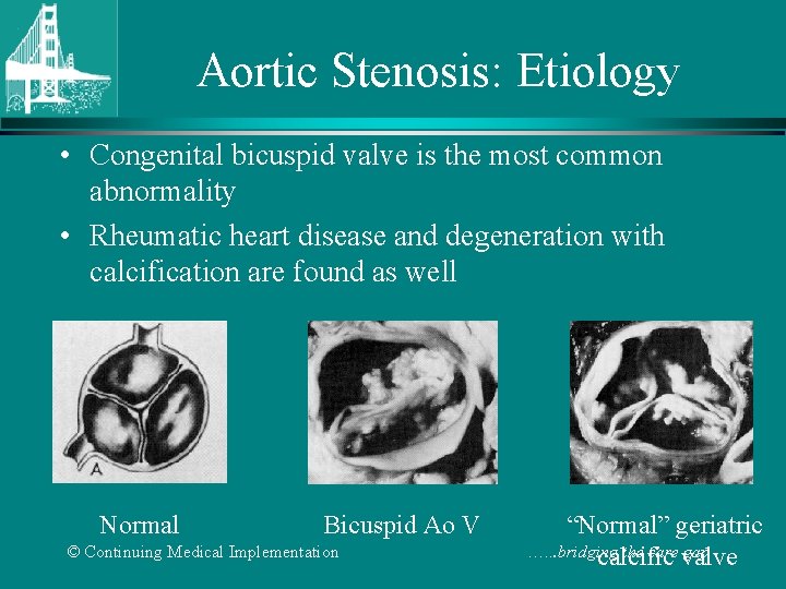 Aortic Stenosis: Etiology • Congenital bicuspid valve is the most common abnormality • Rheumatic