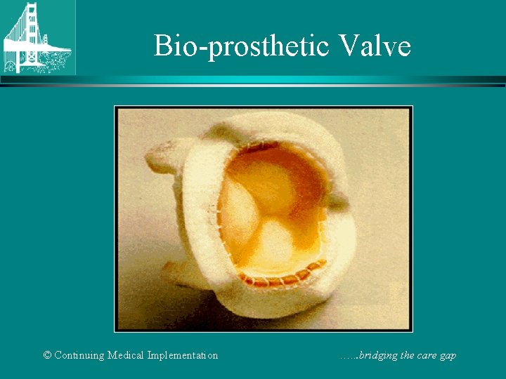 Bio-prosthetic Valve © Continuing Medical Implementation …. . . bridging the care gap 