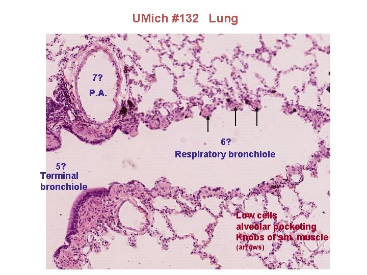 UMich #132 Lung 7? P. A. 6? Respiratory bronchiole 5? Terminal bronchiole Low cells