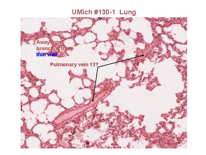 UMich #130 -1 Lung Away from bronchial trees thin wall Pulmonary vein 13? 