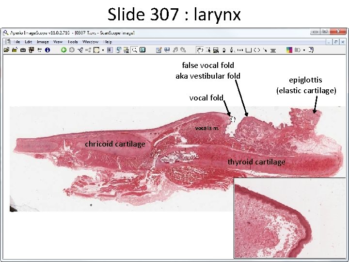 Slide 307 : larynx false vocal fold aka vestibular fold vocal fold epiglottis (elastic