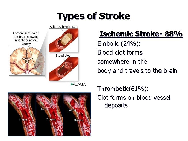 Types of Stroke Ischemic Stroke- 88% Embolic (24%): Blood clot forms somewhere in the