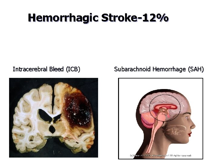 Hemorrhagic Stroke-12% Intracerebral Bleed (ICB) Subarachnoid Hemorrhage (SAH) 