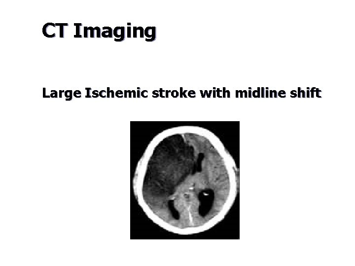 CT Imaging Large Ischemic stroke with midline shift 