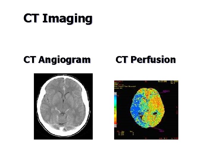 CT Imaging CT Angiogram CT Perfusion 