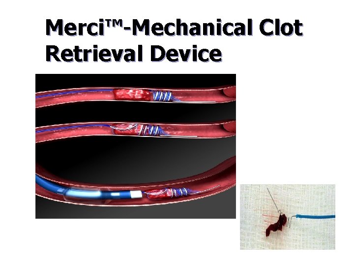 Merci™-Mechanical Clot Retrieval Device 