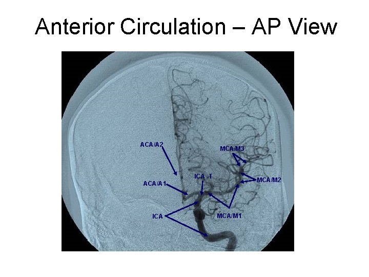 Anterior Circulation – AP View ACA/A 2 MCA/M 3 ICA -T MCA/M 2 ACA/A