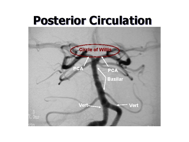 Posterior Circulation Circle of Willis PCA Basilar Vert APM 0189/B/3073, 2007 -12 © Concentric