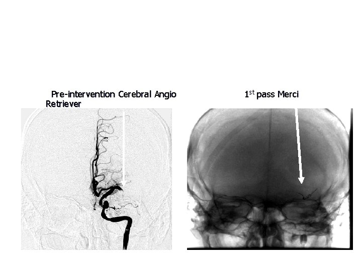 Intervention with Merci Retriever Clot completely blocking flow in the left middle cerebral artery