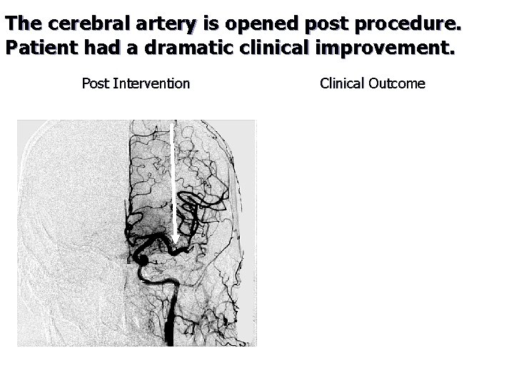 The cerebral artery is opened post procedure. Patient had a dramatic clinical improvement. Post